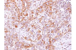 IHC-P Image Lysyl-tRNA synthetase antibody detects KARS protein at cytoplasm on human breast cancer by immunohistochemical analysis.