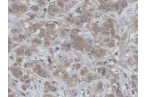 DAB staining on IHC-P; Samples: Human Breast cancer Tissue (HCFC1 抗体  (AA 52-258))