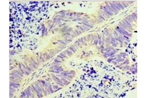 Immunohistochemistry of paraffin-embedded human ovarian cancer using ABIN7154181 at dilution of 1:100 (GLYATL1 抗体  (AA 1-302))