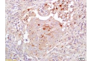 Formalin-fixed and paraffin embedded human colon carcinoma labeled with Anti-EGFL7 Polyclonal Antibody, Unconjugated (ABIN733988) at 1:200 followed by conjugation to the secondary antibody and DAB staining (EGFL7 抗体  (AA 30-80))