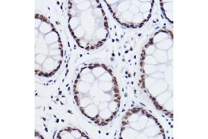 Immunohistochemistry of paraffin-embedded human colon carcinoma using MED4 Rabbit mAb (ABIN7268445) at dilution of 1:100 (40x lens). (MED4 抗体)
