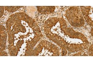 Immunohistochemistry of paraffin-embedded Human cervical cancer tissue using PDP1 Polyclonal Antibody at dilution 1:30 (PDP 抗体)