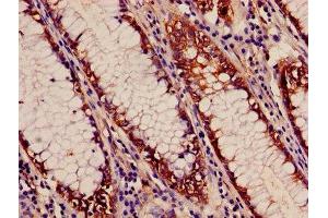 Immunohistochemistry of paraffin-embedded human colon cancer using ABIN7143250 at dilution of 1:100