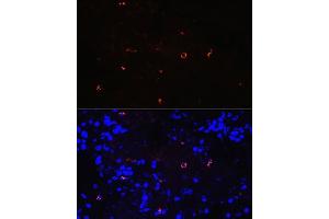 Immunofluorescence analysis of human lung cancer using Lysozyme (LYZ) (LYZ) Rabbit mAb (ABIN7268346) at dilution of 1:100 (40x lens). (LYZ 抗体)