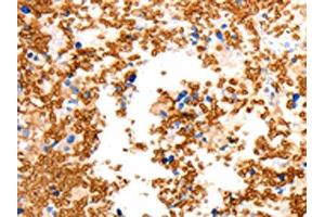 The image on the left is immunohistochemistry of paraffin-embedded Human ovarian cancer tissue using ABIN7192466(SLC2A5 Antibody) at dilution 1/12, on the right is treated with synthetic peptide. (SLC2A5 抗体)