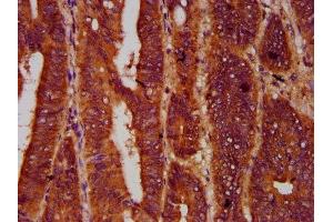 IHC image of ABIN7166132 diluted at 1:600 and staining in paraffin-embedded human colon cancer performed on a Leica BondTM system. (SMG7 抗体  (AA 694-809))