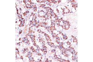 Immunohistochemistry of paraffin-embedded human thyroid cancer using MRPL23 antibody (ABIN7268564) at dilution of 1:100 (40x lens). (MRPL23 抗体  (AA 1-153))