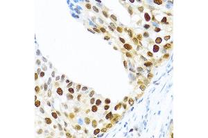 Immunohistochemistry of paraffin-embedded human prostate cancer using KHDRBS2 antibody at dilution of 1:100 (40x lens). (KHDRBS2 抗体)