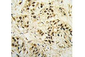 IHC analysis of FFPE human breast carcinoma tissue stained with CDC2 antibody