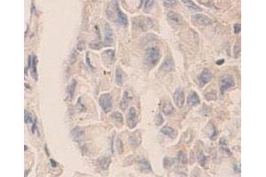Immunohistochemical staining of formalin-fixed paraffin-embedded human lung carcinoma tissue showing cytoplasmic staining with CASP7 polyclonal antibody  at 1 : 100 dilution. (Caspase 7 抗体  (C-Term))