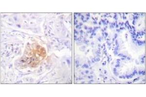 Immunohistochemistry analysis of paraffin-embedded human lung carcinoma tissue, using IL-2R beta/CD122 (Ab-364) Antibody. (IL2 Receptor beta 抗体  (AA 331-380))