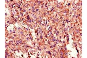 Immunohistochemistry of paraffin-embedded human melanoma using ABIN7172328 at dilution of 1:100 (TANK 抗体  (AA 4-98))