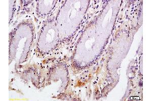 Formalin-fixed and paraffin embedded human gastric carcinoma labeled with Anti-CD72/Ly-32 Polyclonal Antibody, Unconjugated (ABIN741420) at 1:200 followed by conjugation to the secondary antibody and DAB staining (CD72 抗体  (AA 4-110))