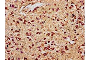 IHC image of ABIN7172459 diluted at 1:300 and staining in paraffin-embedded human glioma performed on a Leica BondTM system. (HNF1B 抗体  (AA 539-704))