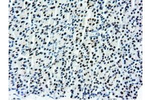 Immunohistochemical staining of paraffin-embedded Carcinoma of Human kidney tissue using anti-NT5DC1 mouse monoclonal antibody. (NT5DC1 抗体)