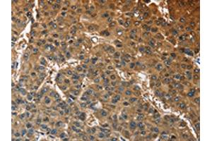 The image on the left is immunohistochemistry of paraffin-embedded Human liver cancer tissue using ABIN7128585(ATP1B2 Antibody) at dilution 1/30, on the right is treated with fusion protein. (ATP1B2 抗体)