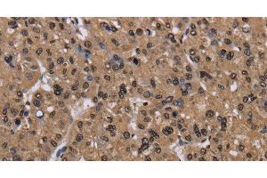 Immunohistochemistry of paraffin-embedded Human liver cancer using CSNK2A1 Polyclonal Antibody at dilution of 1:30 (CSNK2A1/CK II alpha 抗体)