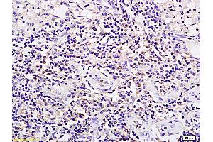 Formalin-fixed and paraffin embedded rat xenograft tumor tissue labeled with Anti SPP24/SPP2 Polyclonal Antibody, Unconjugated (ABIN1385317) followed by conjugation to the secondary antibody and DAB staining (SPP2 抗体  (AA 55-160))