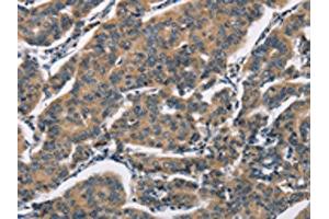 The image on the left is immunohistochemistry of paraffin-embedded Human breast cancer tissue using ABIN7192349(SH2B2 Antibody) at dilution 1/30, on the right is treated with synthetic peptide. (SH2B2 抗体)
