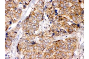 Anti- eIF4A2 Picoband antibody, IHC(P) IHC(P): Human Mammary Cancer Tissue (EIF4A2 抗体  (N-Term))