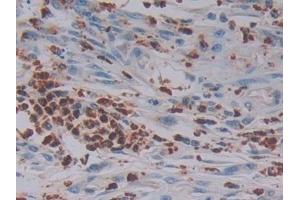 Detection of GZMB in Human Colorectal cancer Tissue using Polyclonal Antibody to Granzyme B (GZMB)