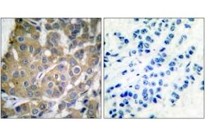 Immunohistochemistry analysis of paraffin-embedded human breast carcinoma tissue, using Cox2 Antibody. (COX2 抗体  (AA 555-604))