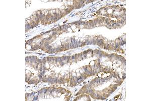 Immunohistochemistry of paraffin-embedded human colon carcinoma using Ube2L3 / UBCH7 Rabbit mAb (ABIN7271178) at dilution of 1:25 (40x lens). (UBE2L3 抗体)