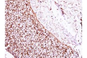 IHC-P Image Immunohistochemical analysis of paraffin-embedded human breast cancer, using Glutamate Dehydrogenase, antibody at 1:250 dilution. (GLUD1 抗体)