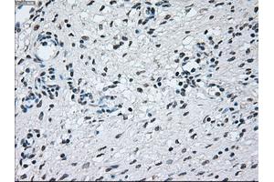 Immunohistochemical staining of paraffin-embedded Adenocarcinoma of colon tissue using anti-BRAFmouse monoclonal antibody. (BRAF 抗体)