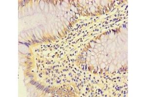 Immunohistochemistry of paraffin-embedded human colon cancer using ABIN7166969 at dilution of 1:100 (RABEP2 抗体  (AA 301-533))