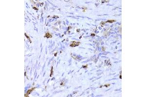 Immunohistochemistry of paraffin-embedded Human adenomyosis using LSP1 antibody at dilution of 1:100 (x400 lens). (LSP1 抗体)