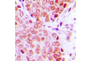 Immunohistochemical analysis of ZNF134 staining in human prostate cancer formalin fixed paraffin embedded tissue section. (ZNF134 抗体  (Center))