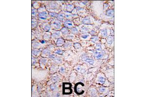 Formalin-fixed and paraffin-embedded human breast carcinoma tissue reacted with MAPK15 polyclonal antibody  , which was peroxidase-conjugated to the secondary antibody, followed by DAB staining. (MAPK15 抗体  (N-Term))