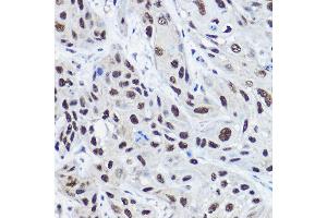 Immunohistochemistry of paraffin-embedded human esophageal cancer using [KO Validated] NCO Rabbit pAb (ABIN6129656, ABIN6144413, ABIN6144414 and ABIN7101354) at dilution of 1:100 (40x lens). (NCOA2 抗体  (AA 550-820))