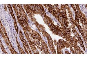 ABIN6267130 at 1/100 staining Human thyroid cancer tissue by IHC-P.