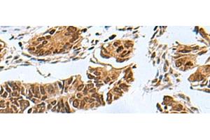 Immunohistochemistry of paraffin-embedded Human colorectal cancer tissue using PDCD5 Polyclonal Antibody at dilution of 1:55(x200) (PDCD5 抗体)