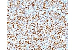 Formalin-fixed, paraffin-embedded human mantle cell lymphoma stained with CCND1 antibody. (Cyclin D1 抗体)