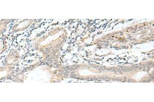 Immunohistochemistry of paraffin-embedded Human esophagus cancer tissue using NXNL1 Polyclonal Antibody at dilution of 1:45(x200) (NXNL1 抗体)