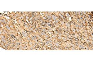 Immunohistochemistry of paraffin-embedded Human cervical cancer tissue using UBE2A Polyclonal Antibody at dilution of 1:45(x200) (UBE2A 抗体)