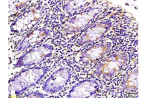 Formalin-fixed and paraffin-embedded : human colon carcinoma labeled with Rabbit Anti-WNK3 protein Polyclonal Antibody (ABIN675713), Unconjugated 1:200 followed by conjugation to the secondary antibody (WNK3 抗体  (AA 451-550))