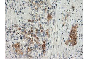 Immunohistochemical staining of paraffin-embedded Adenocarcinoma of Human breast tissue using anti-SNAP25 mouse monoclonal antibody. (SNAP25 抗体)