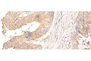 Immunohistochemistry of paraffin-embedded Human colorectal cancer tissue using MYDGF Polyclonal Antibody at dilution of 1:25(x200) (MYDGF 抗体)