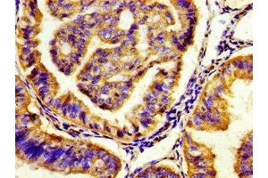 Immunohistochemistry of paraffin-embedded human endometrial cancer using ABIN7142644 at dilution of 1:100 (HTR7 抗体  (AA 1-83))