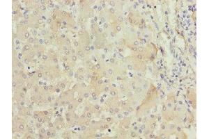 Immunohistochemistry of paraffin-embedded human liver tissue using ABIN7152640 at dilution of 1:100 (FABP1 抗体  (AA 1-127))