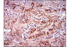 Immunohistochemical analysis of paraffin-embedded endometrial cancer tissues using NT5E mouse mAb with DAB staining. (CD73 抗体  (AA 30-250))