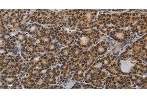 Immunohistochemistry of paraffin-embedded Human thyroid cancer tissue using SMAD7 Polyclonal Antibody at dilution 1:40 (SMAD7 抗体)