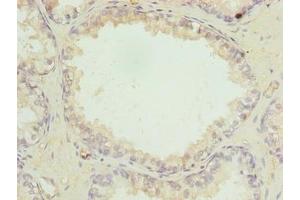 Immunohistochemistry of paraffin-embedded human prostate cancer using ABIN7158525 at dilution of 1:100 (ACSBG1 抗体  (AA 351-600))