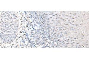 Immunohistochemistry of paraffin-embedded Human esophagus cancer tissue using EPM2A Polyclonal Antibody at dilution of 1:55(x200) (EPM2A 抗体)