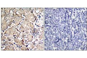 Immunohistochemical analysis of paraffin-embedded human breast carcinoma tissue using FKHR(Phospho-Ser319) Antibody(left) or the same antibody preincubated with blocking peptide(right). (FOXO1 抗体  (pSer319))