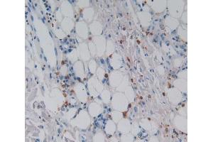 IHC-P analysis of skin cancer tissue, with DAB staining. (CSF2RA 抗体  (AA 28-112))